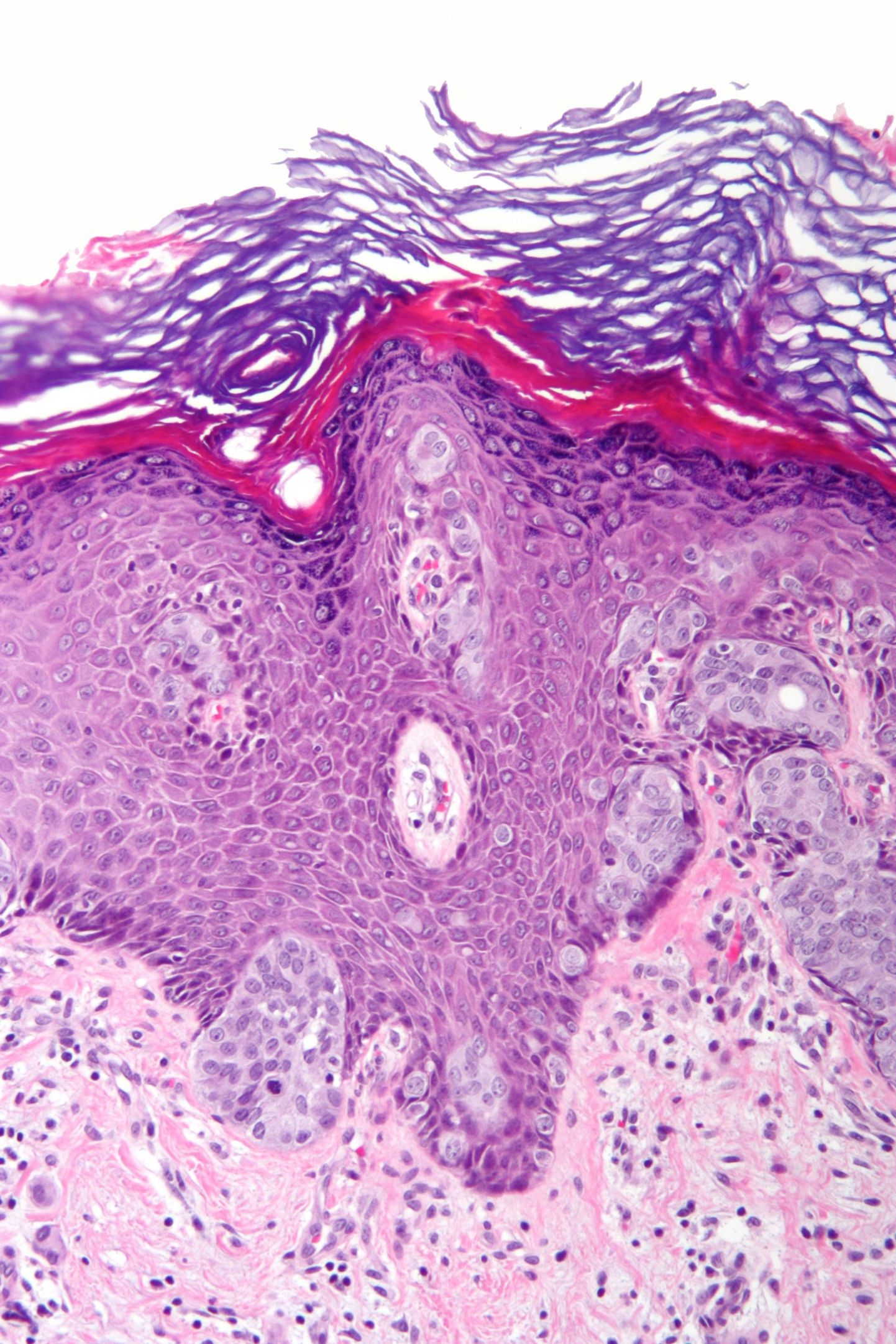 Kartsinoom tüüpi vähi rakud. FOTO: Wikipedia/Cc By-sa 3.0