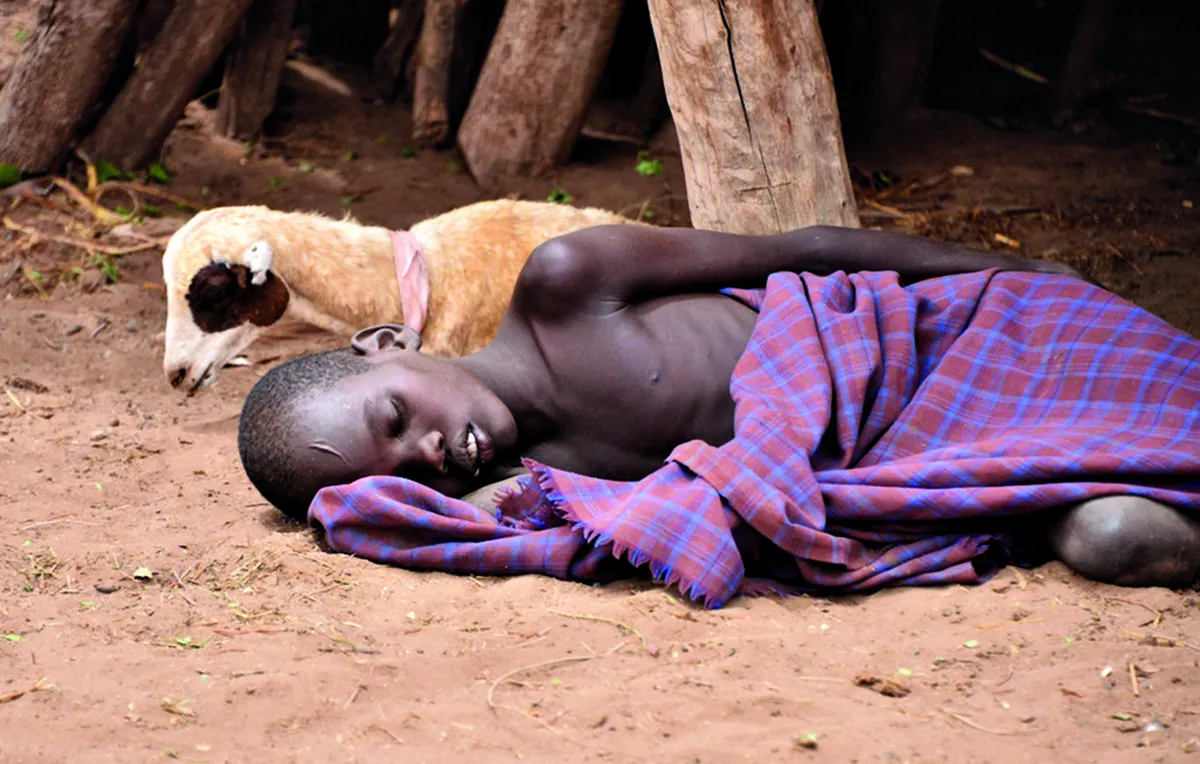 Malaariasse haigestunud laps Etioopias Nyangatonis. Iga päev sureb Sahara kõrbest lõuna poole jäävates Aafrika riikides malaariasse umbes 2000 last.