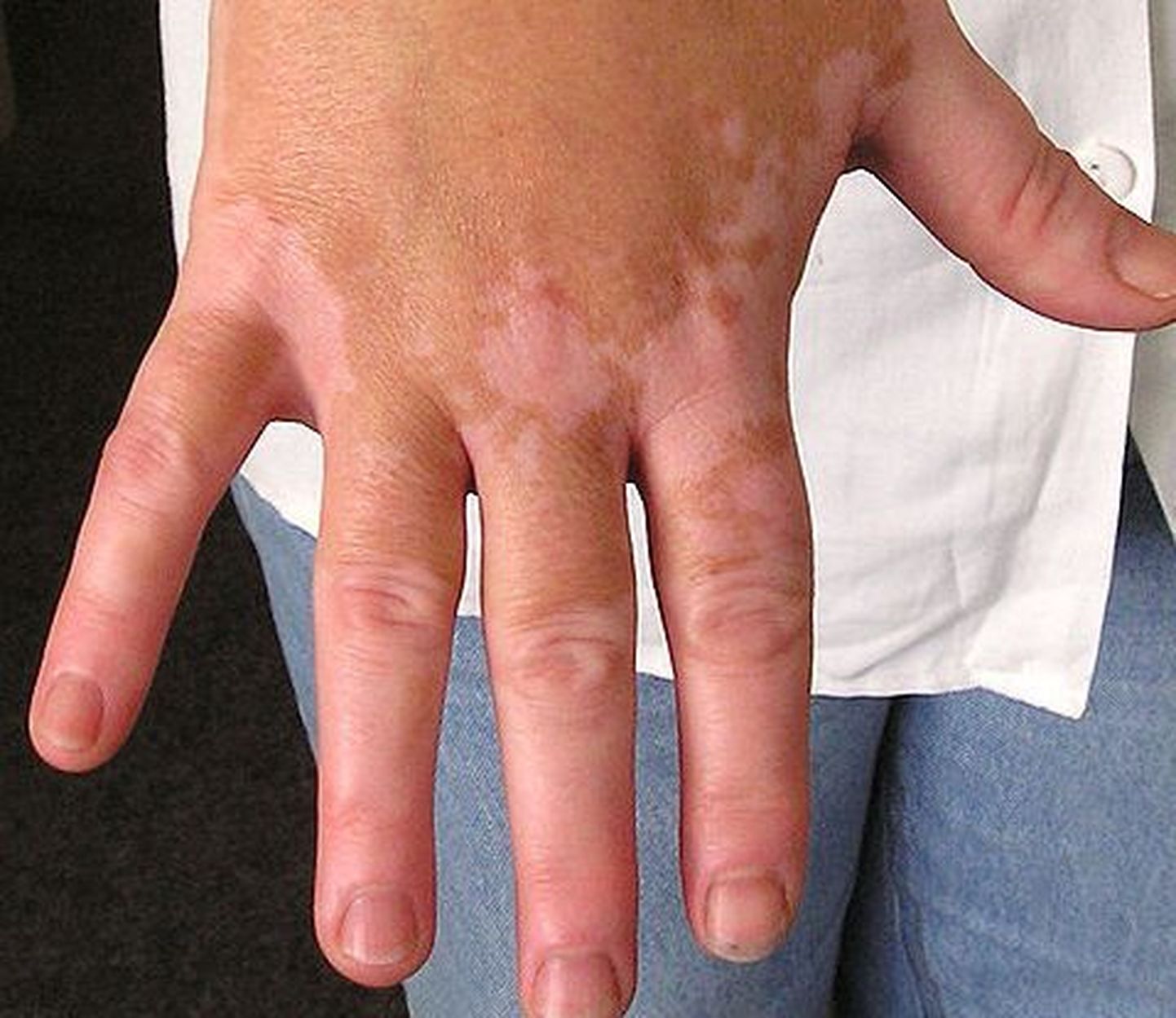 Vitiligo ehk naha laikpigmenditus