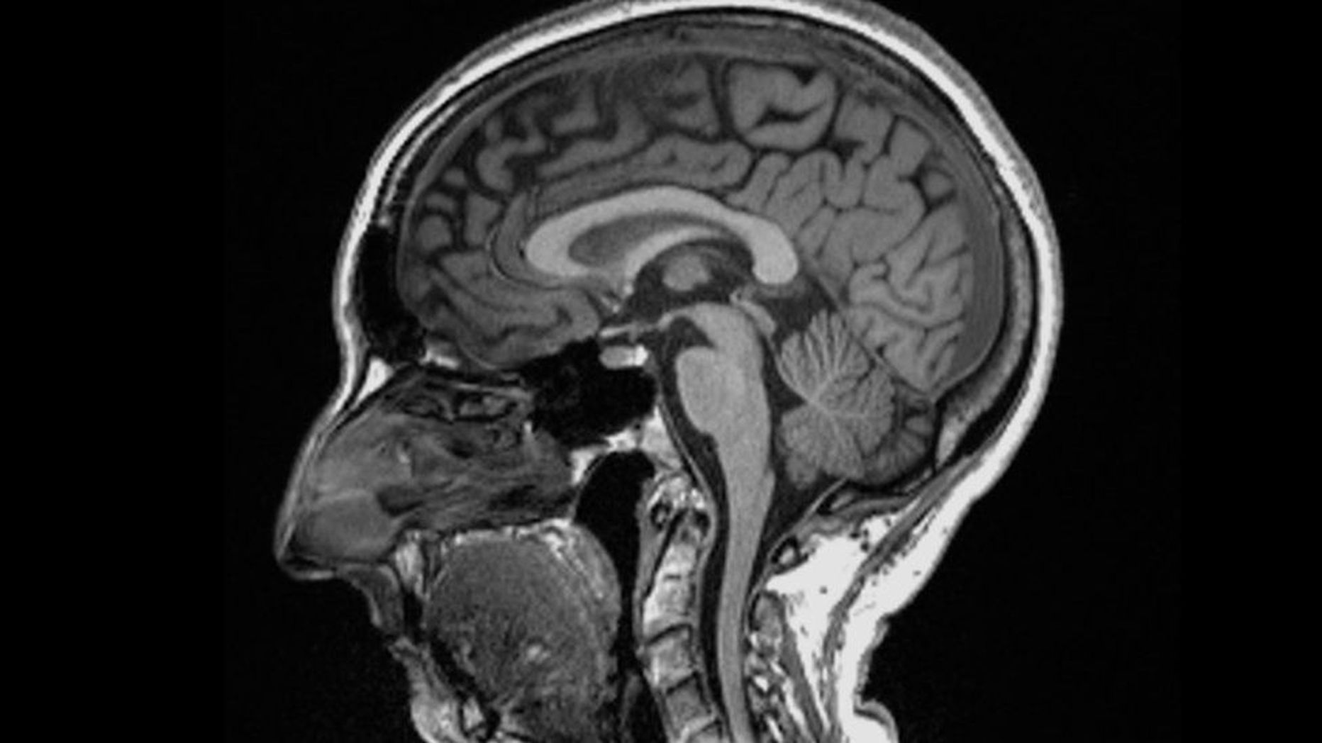 Ka kerge koroona infektsioon võib põhjustada hallaine kadu teatud aju piirkondades.