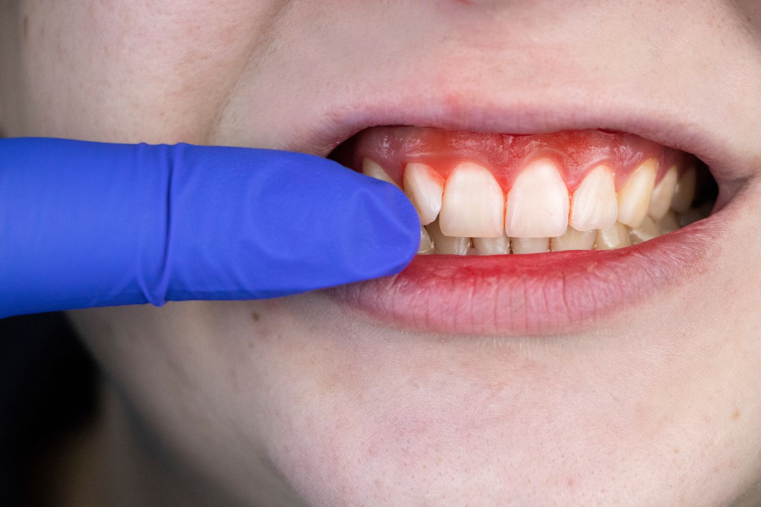 Veritsus hambaid pestes on üks parodontiidi tunnus.