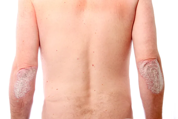 Bioloogilised ravimid võivad naha psoriaasist täielikult vabastada