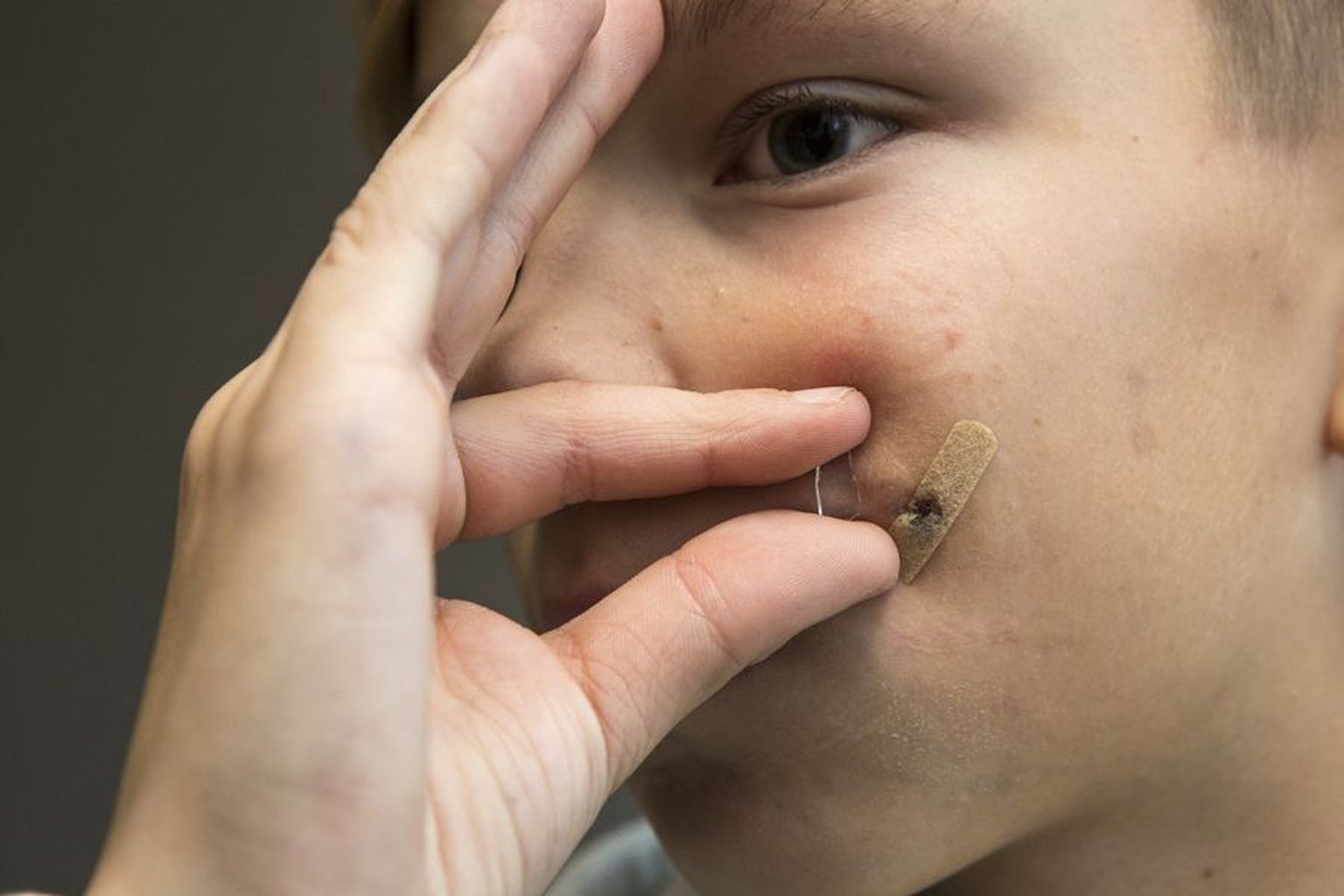 11-aastasel koolipoisil Hendril, kes seitse aastat tagasi liiklusõnnetuses vigastada sai, on põsel plaaster. Selle all paraneb haav, millest kirurg alles eelmisel nädalal killu välja tõmbas.