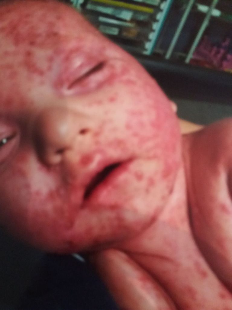 Paljud toidud tekitavad lapsele allergia ning nägu paistetab üles.
